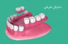 سازنده دندان مصنوعی ثابت در شرق تهران