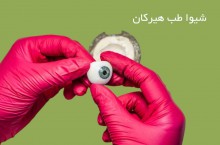 پروتز چشم در شیراز