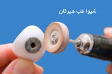 بهترین مرکز ساخت چشم مصنوعی شیراز