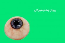 بهترین پروتز چشم در ایران